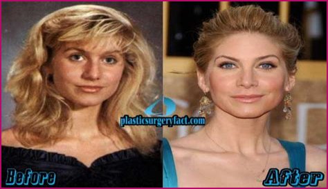 Elizabeth Mitchell Plastic Surgery Before and After